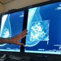 Las nuevas directrices sugieren que las mujeres deben hacerse antes las pruebas de detección del cáncer de mama